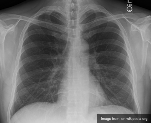 CXR